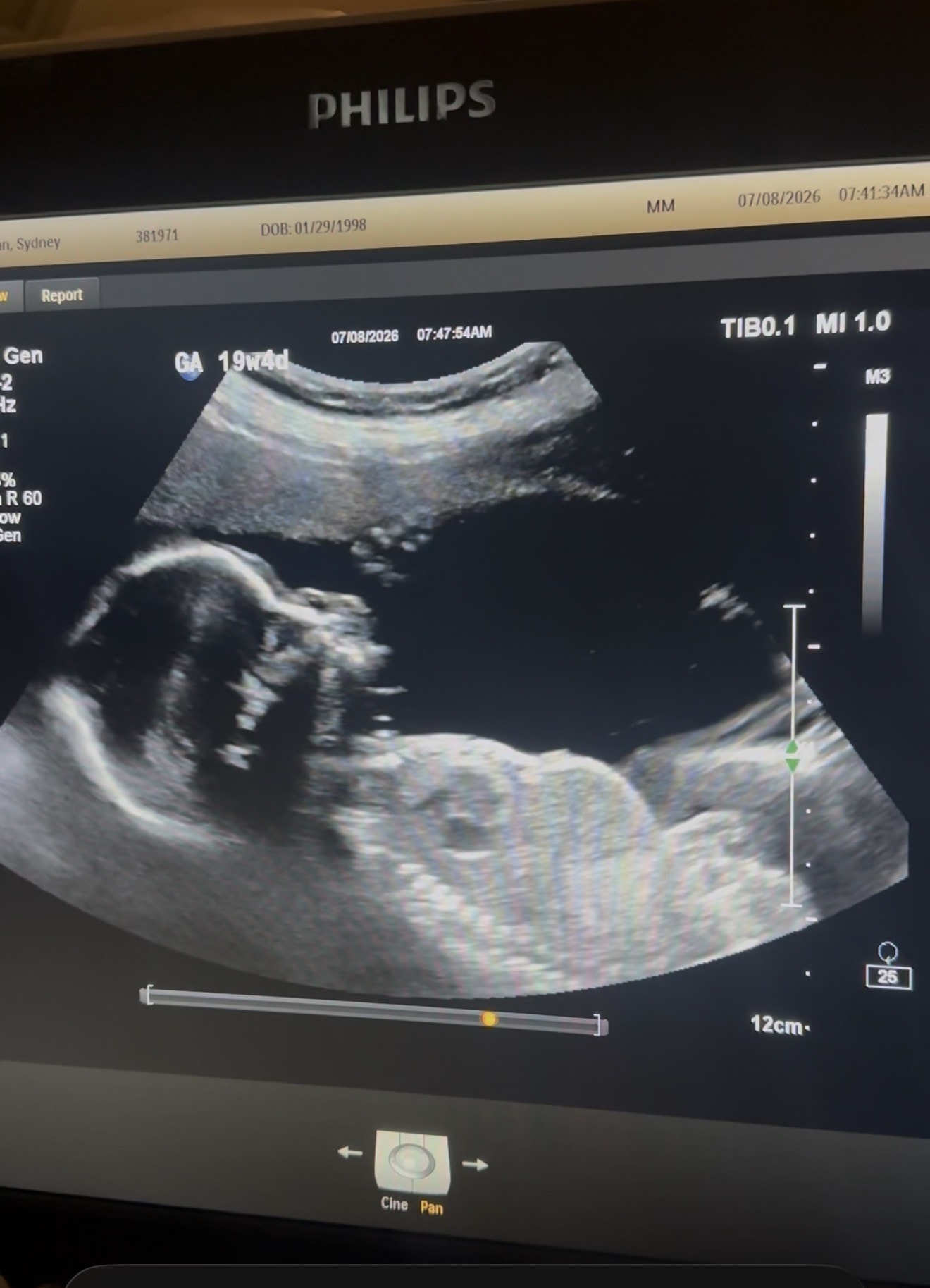 Ultrasound photo of baby Chance